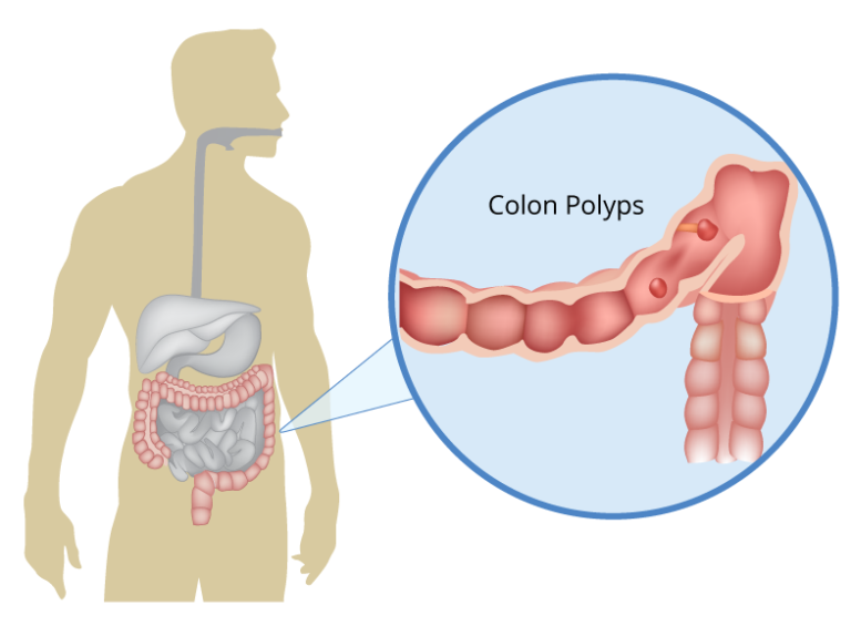 Colon Polyps | Growth on the Intestinal Lining | Treatment Options
