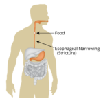 Dysphagia or Airway Blockage? What is the Difference & Treatment?