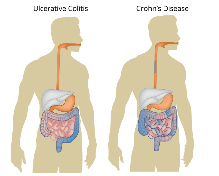Crohn's Disease - Colorectal and Gastro Clinic